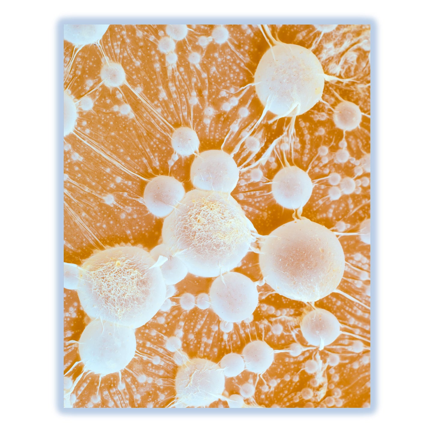 Cancer Tumors with Metastases Oncology Oncologist Doctor 8"x10" Wall Art Print