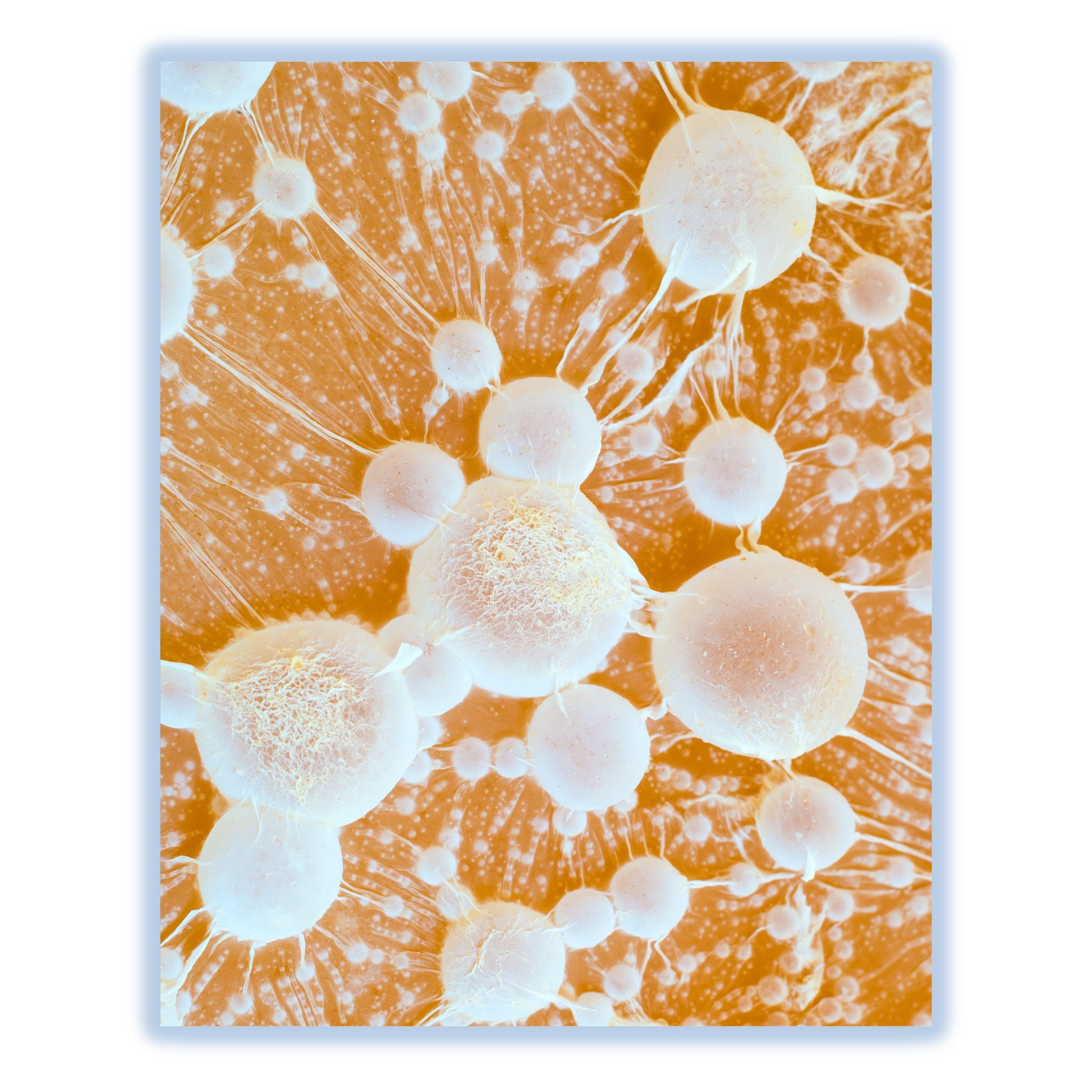 Cancer Tumors with Metastases Oncology Oncologist Doctor 8"x10" Wall Art Print
